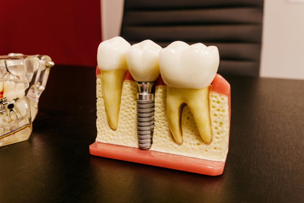 The Life-Changing Benefits of Dental Implants